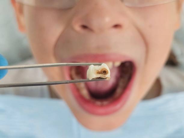 Best Emergency Treatment for Toothache in Red Oak, IA
